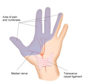 Carpal Tunnel surgery, Lander Wyoming