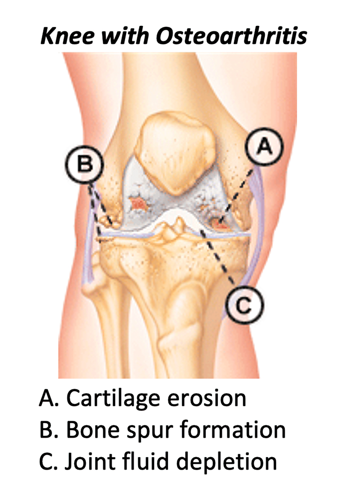 osteo1